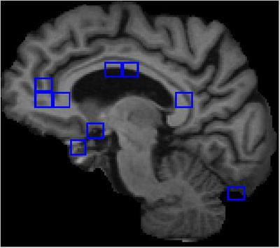 Image of an Alzheimer's Patient